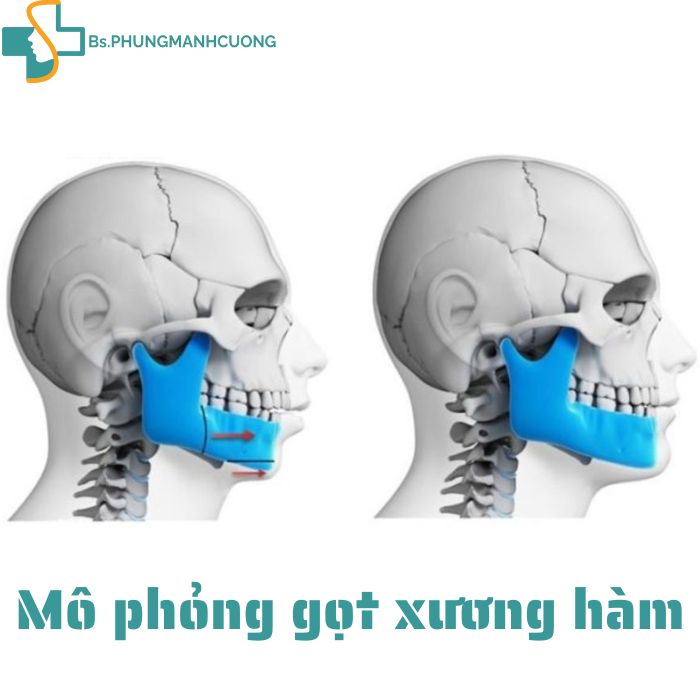 Gọt hàm V-line – Bí quyết sở hữu mặt thon gọn ai cũng mê 5 gọt hàm v-line