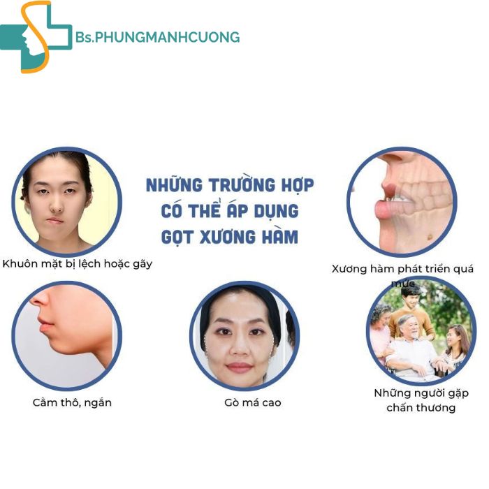 Trường hợp gọt xương hàm