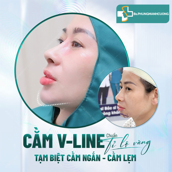 Độn cằm Korea Implant: Cằm V-line nhẹ nhàng, chuẩn đẹp Á Đông 6 Độn cằm Korea Implant