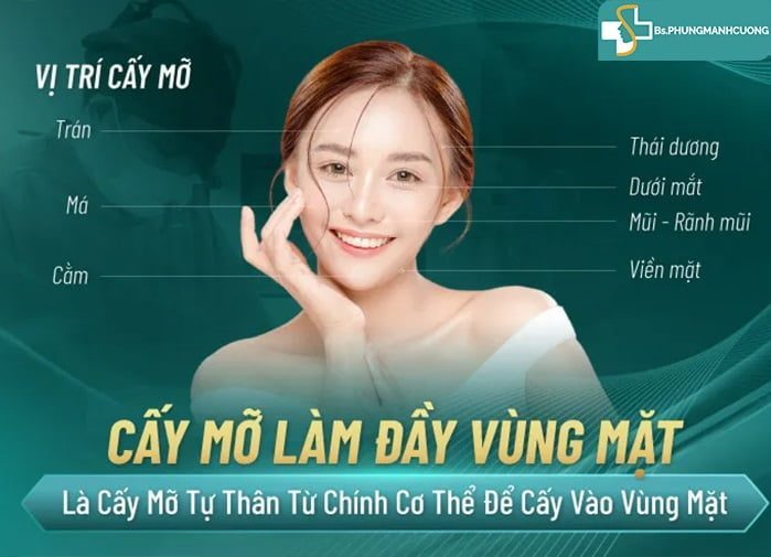 Phẫu thuật cấy mỡ má - Giải pháp làm đẹp khuôn mặt tự nhiên 6 Phẫu thuật cấy mỡ má