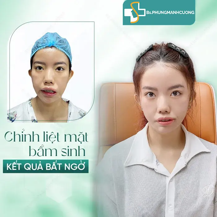 Khách hàng trước và sau khi điều trị liệt mặt tại bác sĩ Phùng Mạnh Cường