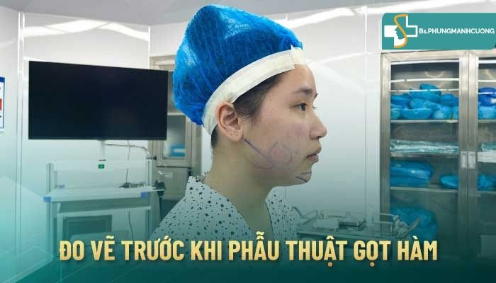 gọt hàm v-line