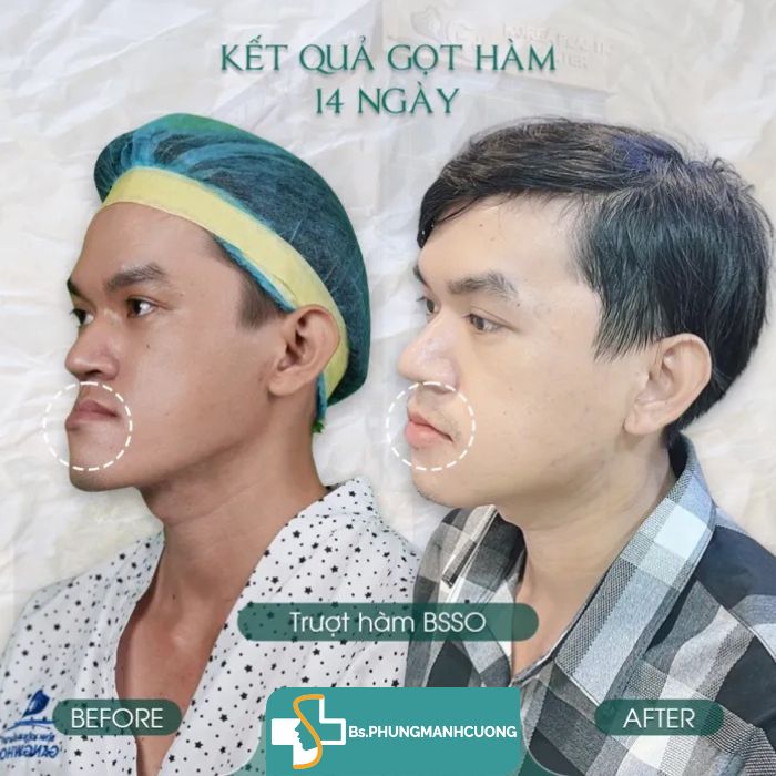gọt hàm v line
