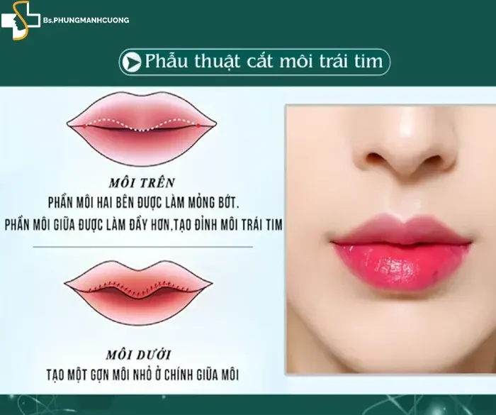 Cắt môi trái tim: Giải pháp cho đôi môi quyến rũ và gợi cảm 5 Cắt môi trái tim là gì?