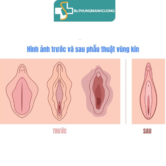 Tái Sinh Vẻ Đẹp, Khơi Dậy Sự Quyến Rũ Với Công Nghệ Phẫu Thuật Thẩm Mỹ Vùng Kín 9 thẩm mỹ vùng kín