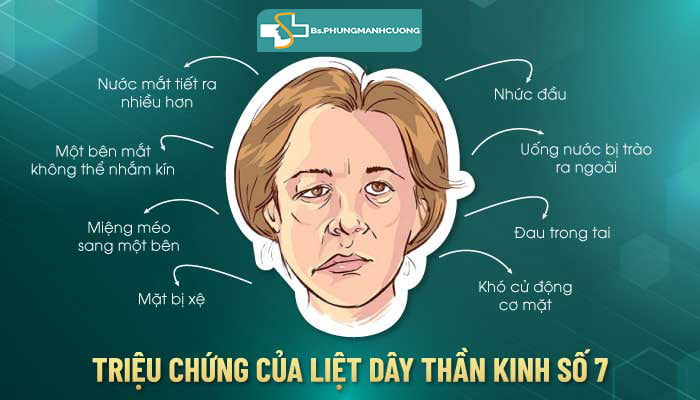 Các triệu chứng của liệt dây thần kinh số 7