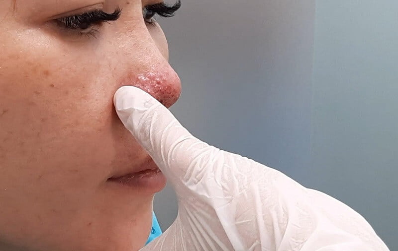 nâng mũi có tháo ra được không