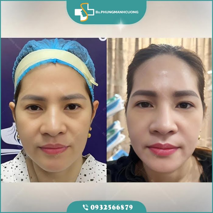 cắt mí dưới perfect