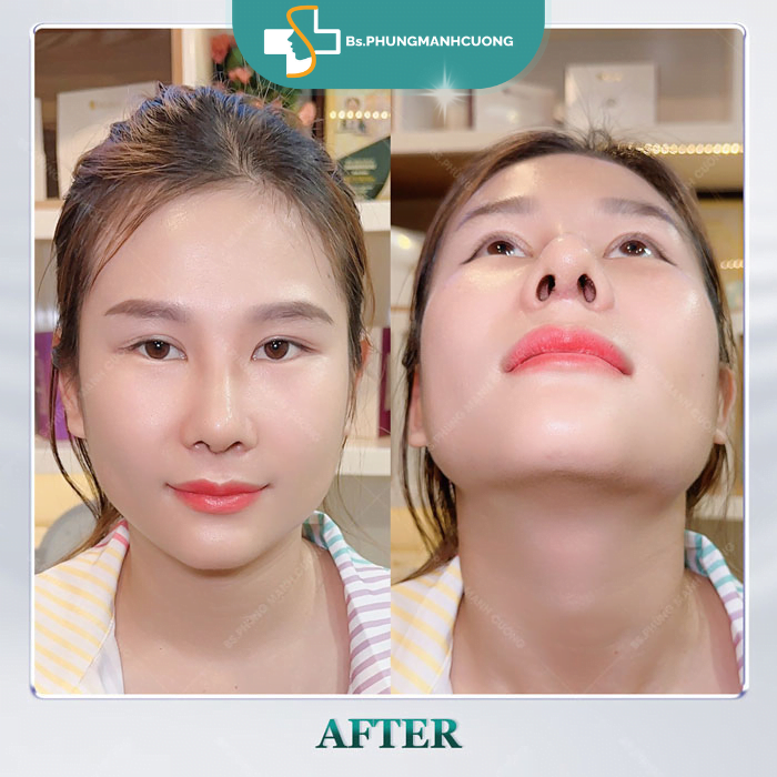 Độn cằm Korea Implant: Cằm V-line nhẹ nhàng, chuẩn đẹp Á Đông 7 don cam 9
