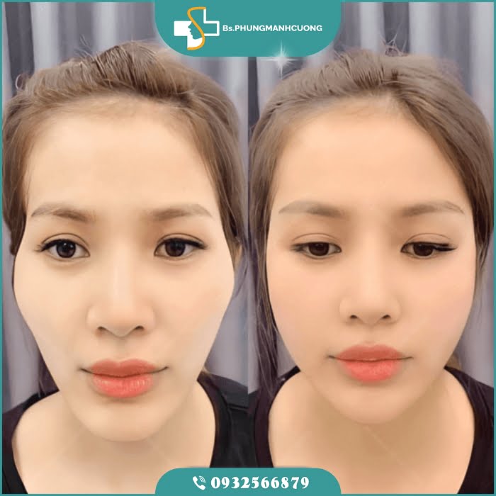 độn thái dương