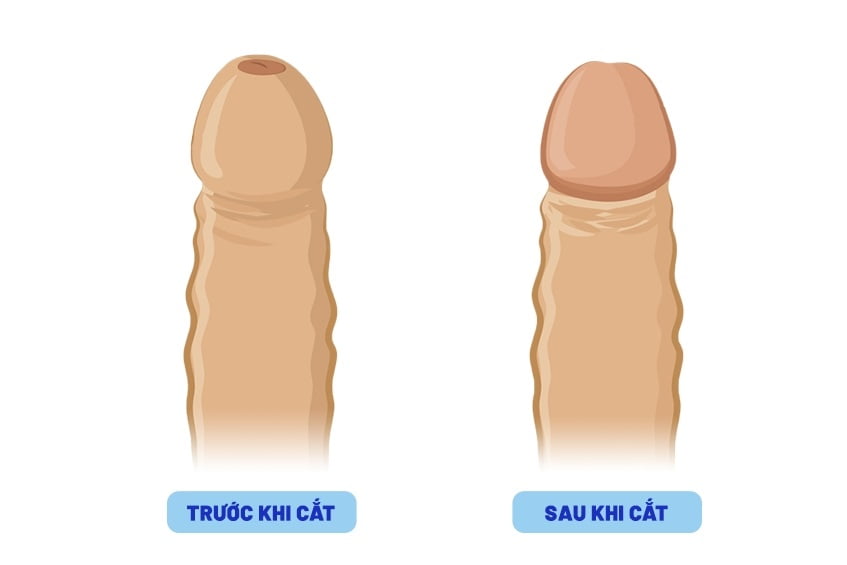 Giới thiệu phương pháp cắt bao quy đầu đẹp tự nhiên, an toàn 6 Cắt bao quy đầu đẹp tự nhiên