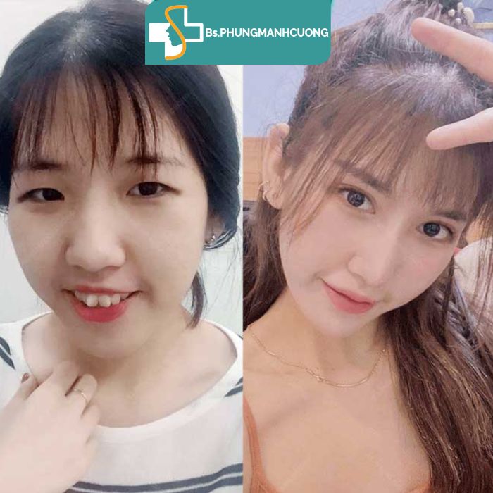 kết quả bấm mí hàn quốc