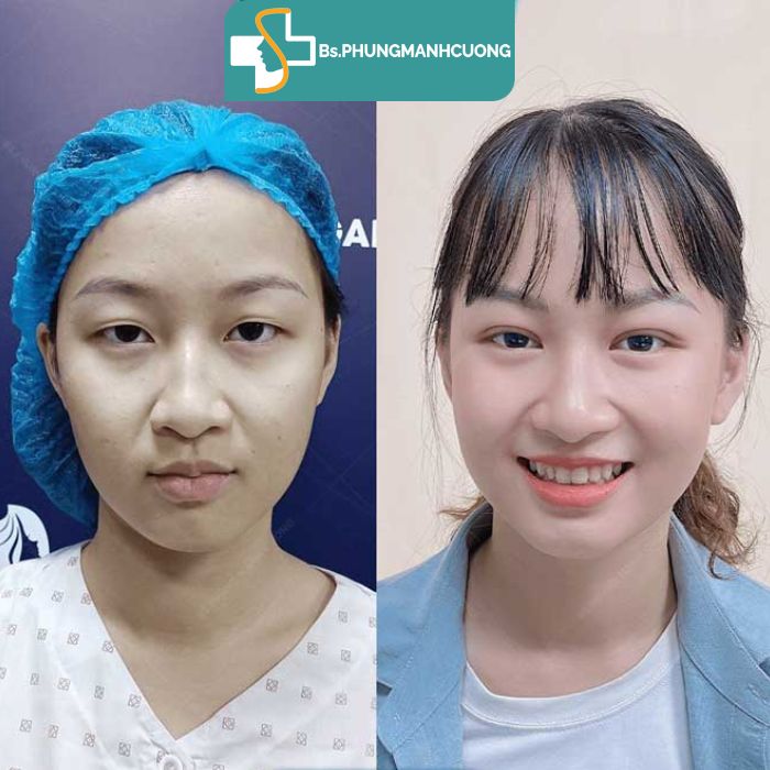 kết quả bấm mí hàn quốc