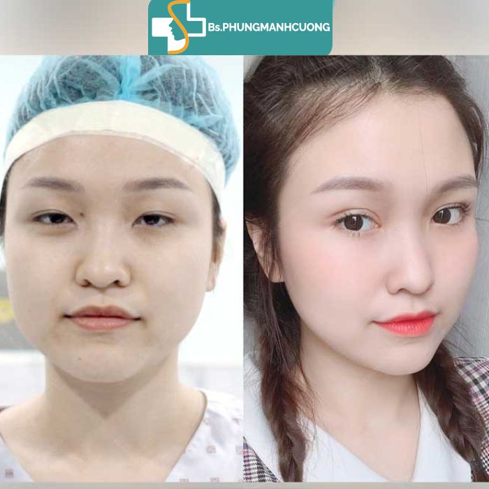 kết quả bấm mí hàn quốc