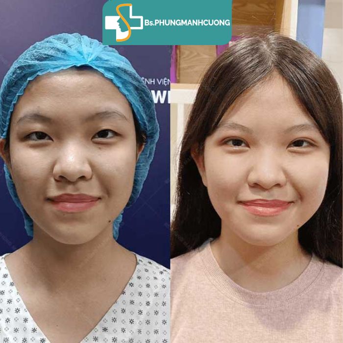 kết quả bấm mí hàn quốc