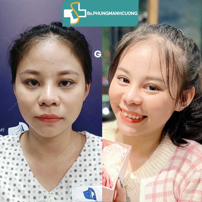 kết quả bấm mí hàn quốc