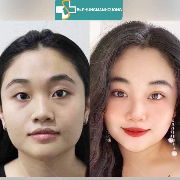 kết quả bấm mí hàn quốc