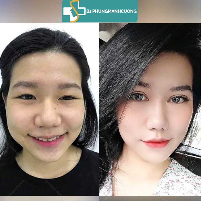 kết quả bấm mí hàn quốc