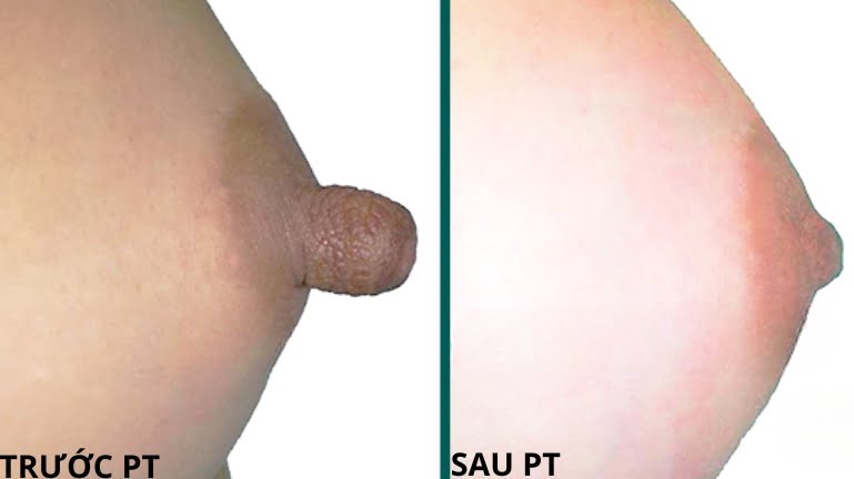cách làm đầu ti nhỏ lại