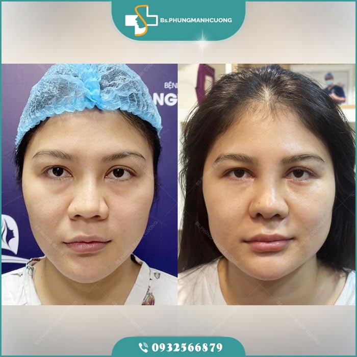 mở rộng góc mắt