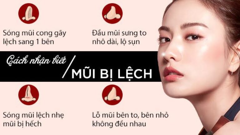 Làm sao để khắc phục nâng mũi bị lệch an toàn, không để lại biến chứng? 5 nâng mũi bị lệch