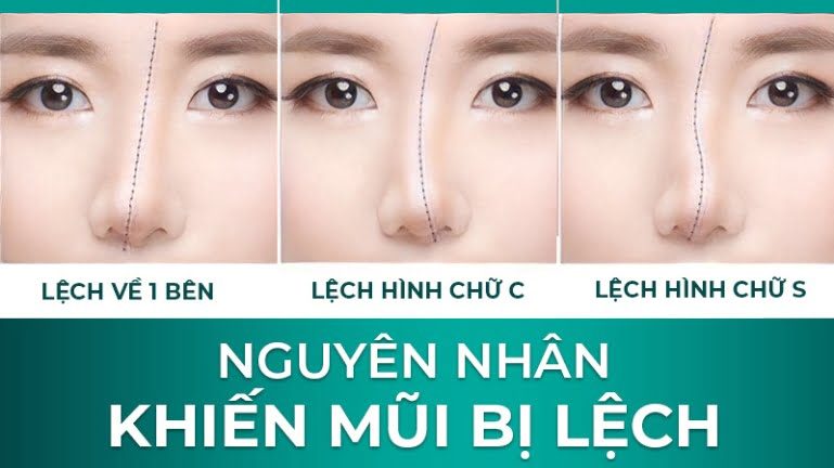 Làm sao để khắc phục nâng mũi bị lệch an toàn, không để lại biến chứng? 6 nâng mũi bị lệch