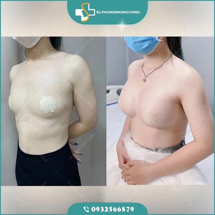 nâng ngực bằng mỡ tự thân