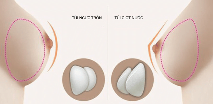 nâng ngực giọt nước