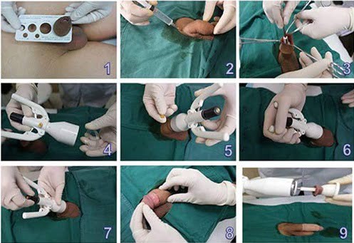 Điều Gì Ẩn Sau Quyết Định Cắt Bao Quy Đầu Của Hàng Triệu Nam Giới? 21 quy trinh cat bao quy dau 1