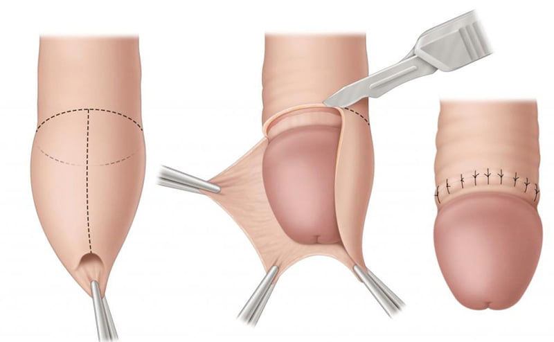 Gợi ý địa chỉ cắt bao quy đầu đẹp và an toàn hiện nay 6 quy trình cắt bao quy đầu