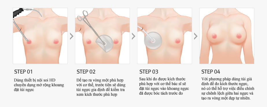 quy trình nâng ngực nội soi