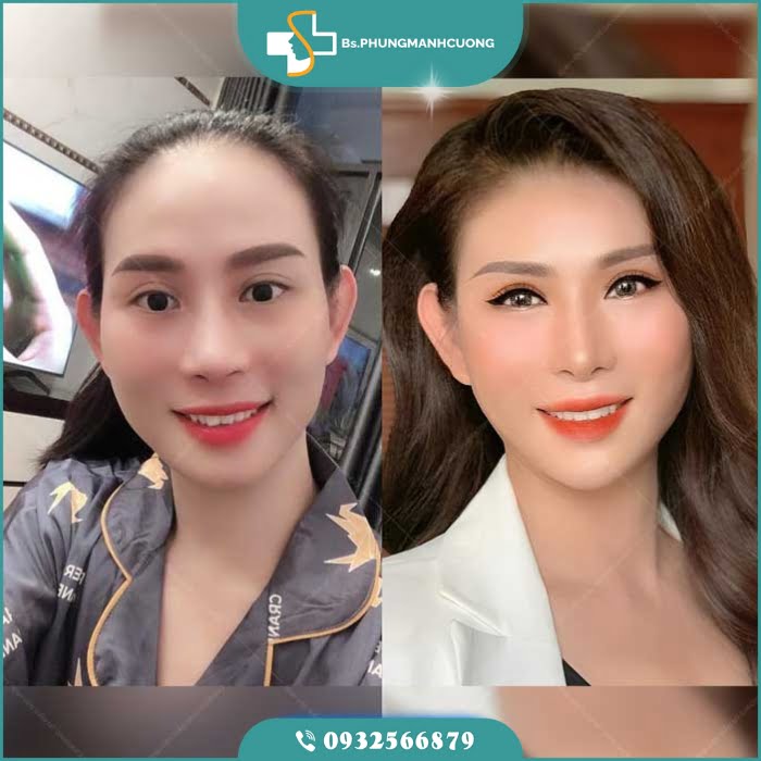 sửa mí hỏng