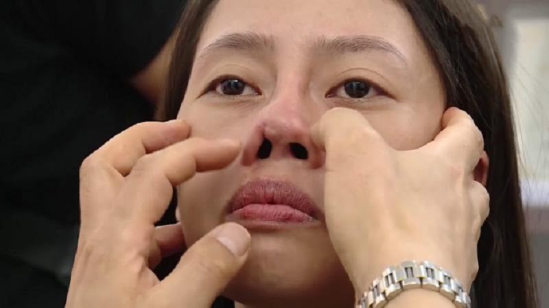 nâng mũi có tháo ra được không