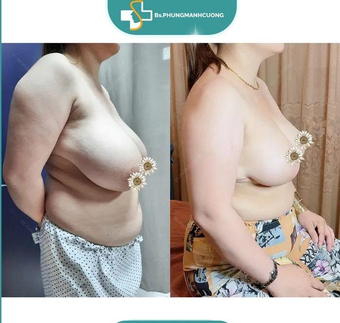 Phẫu thuật sửa ngực: Giải pháp hoàn hảo cho vòng 1 tự tin 6 thu nho nguc phi dai4 e1751093057301