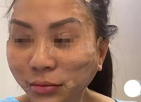 có nên căng da mặt không