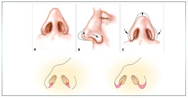 có nên thu nhỏ đầu mũi không