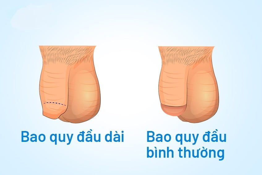 Cách chữa dài bao quy đầu an toàn, hỗ trợ sinh lý nam giới 6 dài bao quy đầu