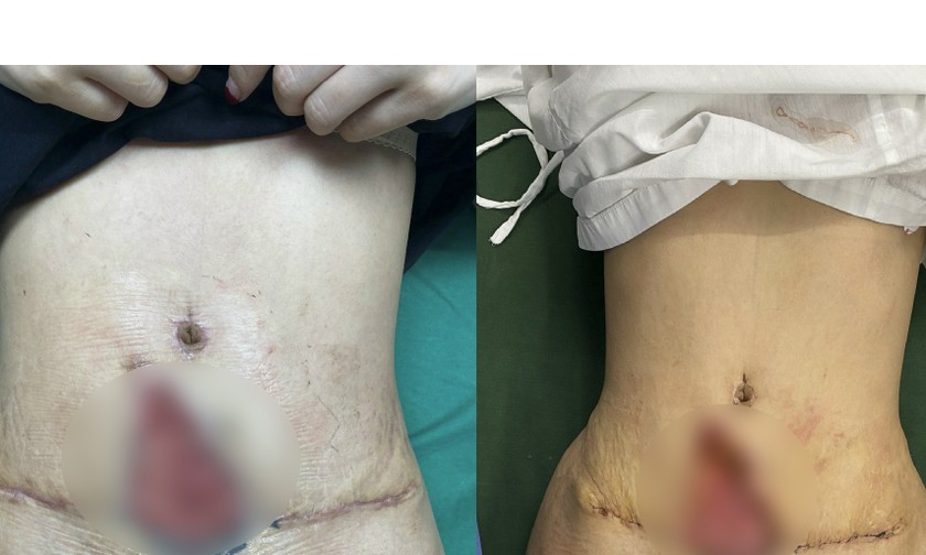 hút mỡ bụng có ảnh hưởng gì không