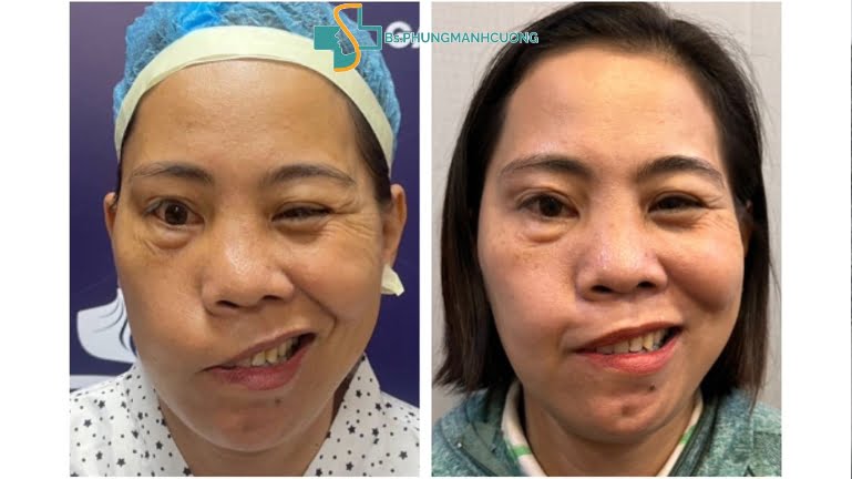 méo miệng mắt nhắm không kín