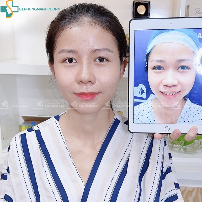 phương pháp nâng mũi tốt nhất hiện nay