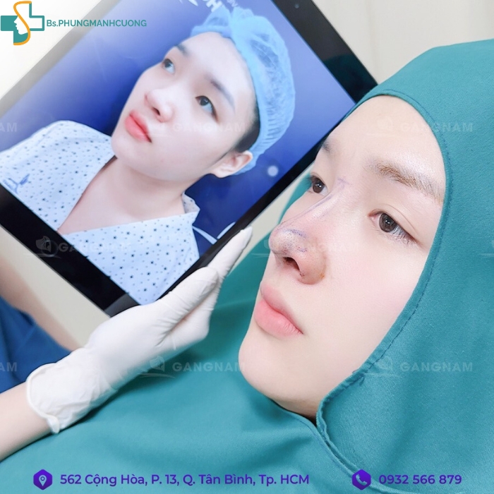 phương pháp nâng mũi tốt nhất hiện nay