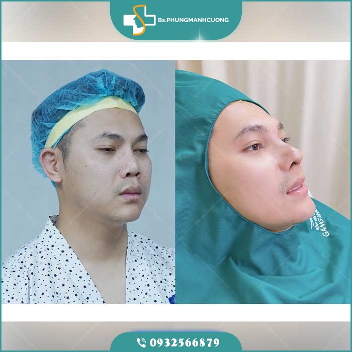nâng mũi sụn sườn