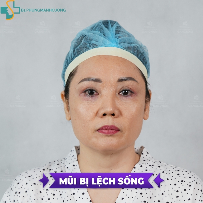 phương pháp nâng mũi