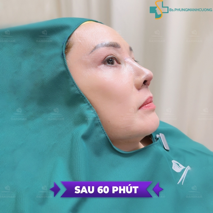 Phẫu thuật chỉnh hình mũi: Giải pháp thẩm mỹ và chức năng toàn diện 5 Phẫu thuật chỉnh hình mũi