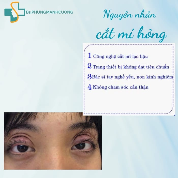 Cắt Mí Hỏng Có Sửa Được Không? Giải Pháp Khắc Phục Tốt Nhất 8 cắt mí hỏng có sửa được không