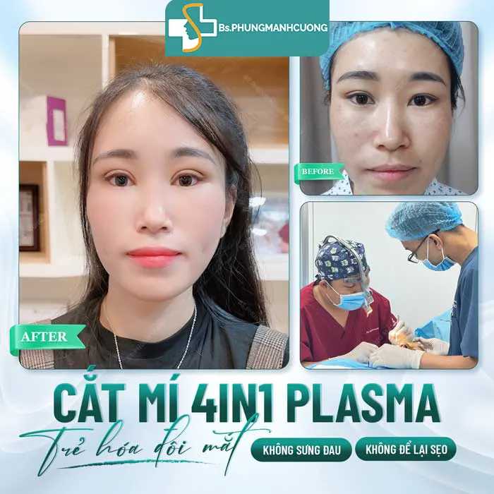 cắt mí có đau không