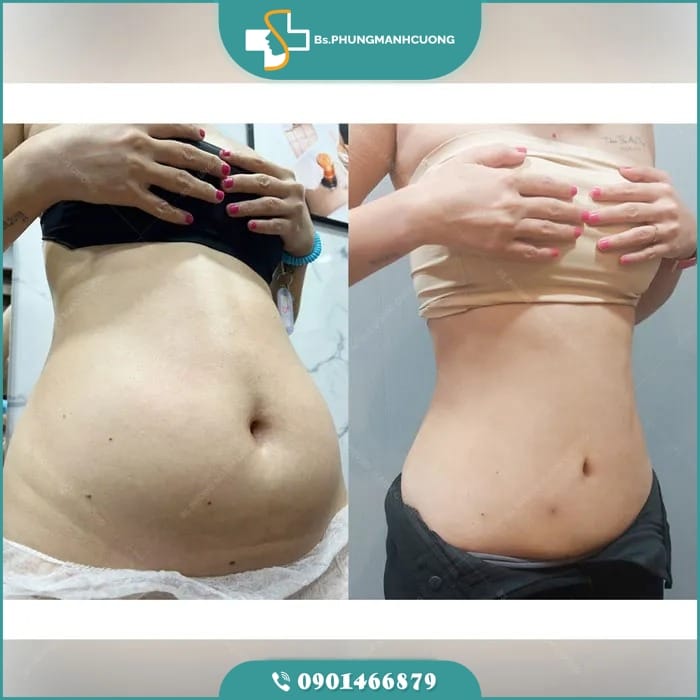 công nghệ giảm mỡ bụng không phẫu thuật