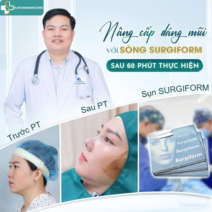 sống mũi surgiform