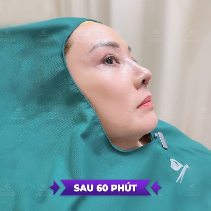 review sửa mũi