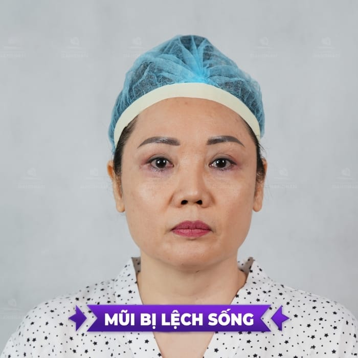 review sửa mũi
